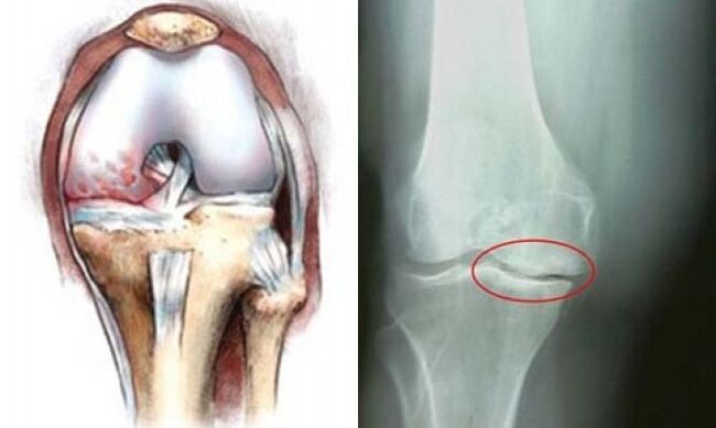 arthrose des kniees röntgen