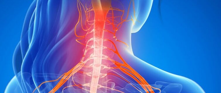 Kompression der Gefäße des Rückenmarks bei Osteochondrose der Halswirbelsäule