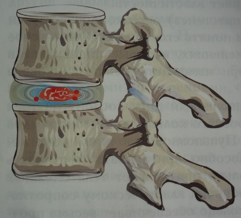 Schädigung des Nucleus pulposus der Bandscheibe im ersten Stadium der zervikalen Osteochondrose