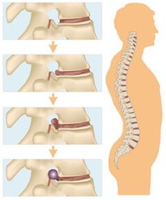 Vier Stadien der Entwicklung der zervikalen Osteochondrose