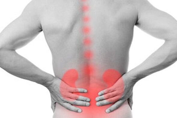 Nierenpathologien können das Auftreten von Schmerzen im unteren Rückenbereich hervorrufen
