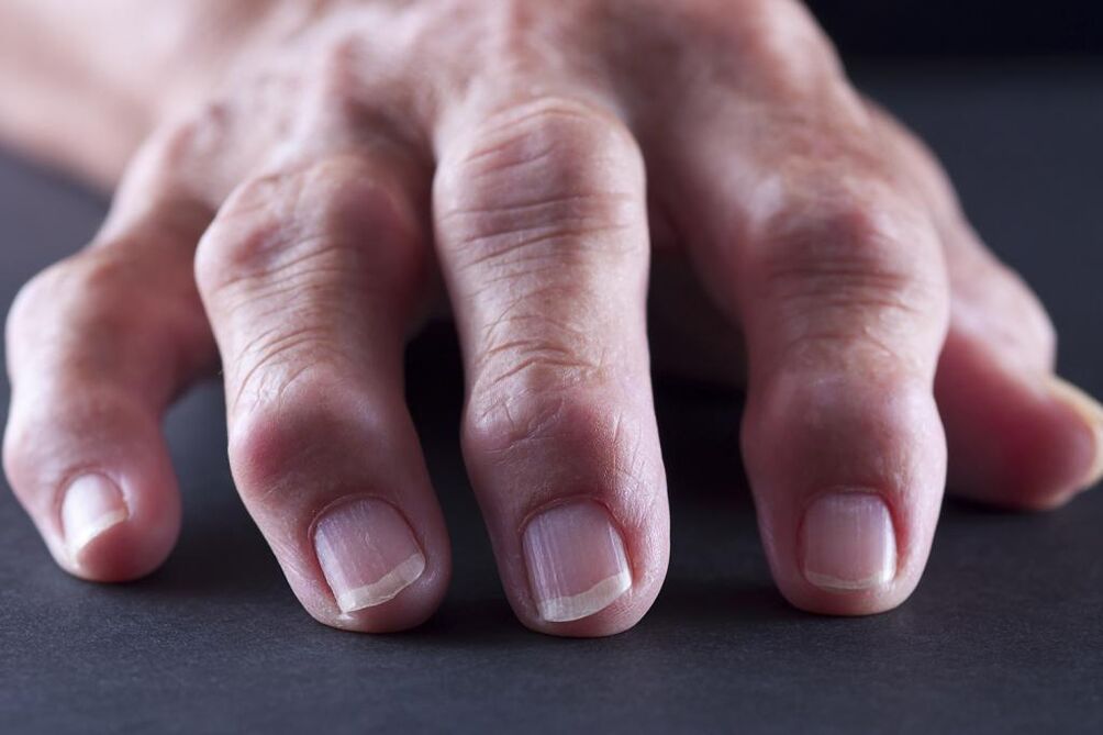 Eine Schleimbeutelentzündung ist durch Schmerzen, Entzündungen und Schwellungen der Fingergelenke gekennzeichnet