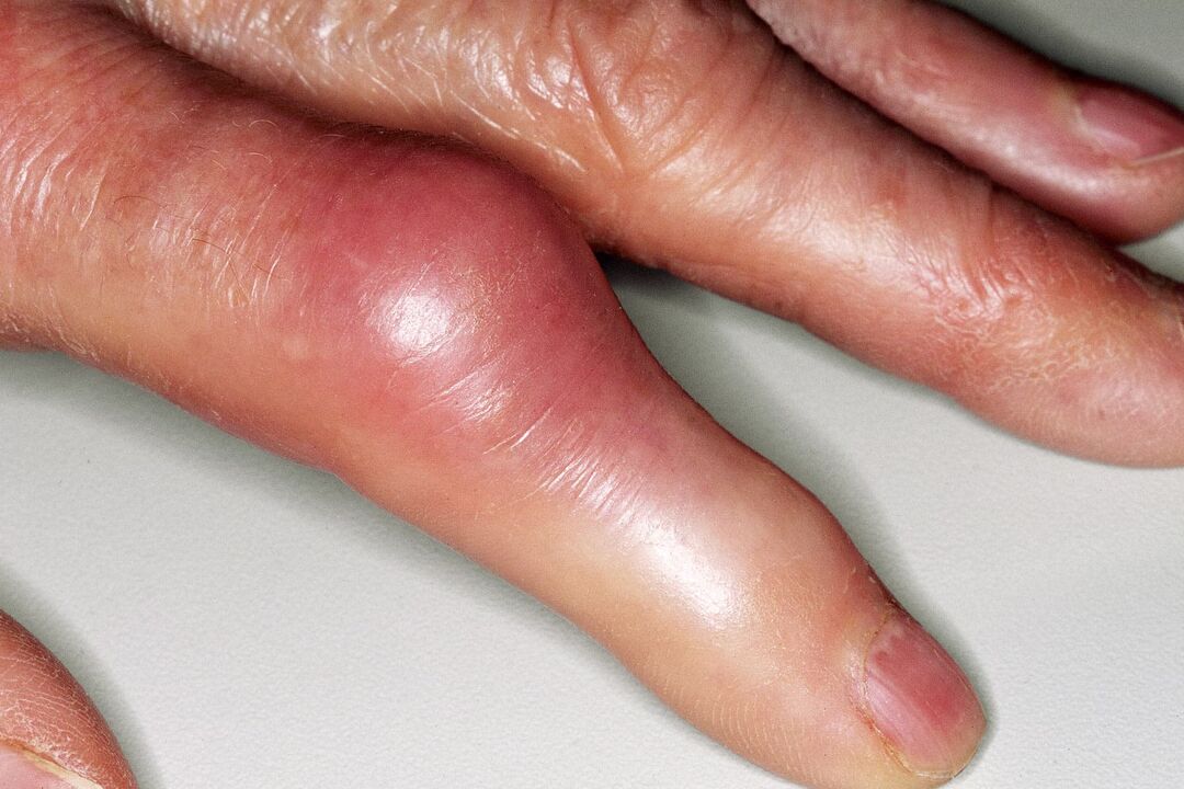 Schwellung, Verformung des Fingergelenks und akute Schmerzen nach einer Verletzung