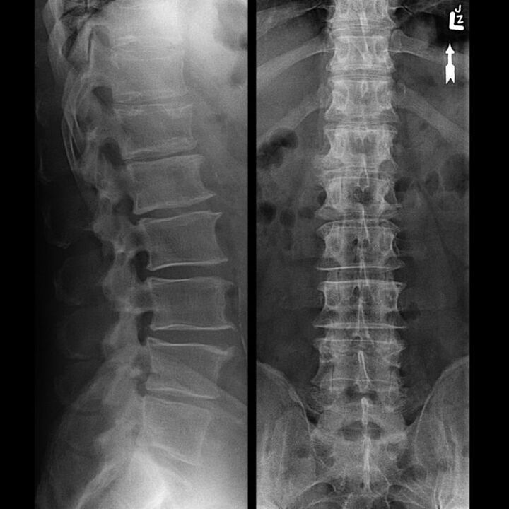 Sncing der Wirbelsäule mit Osteochondrose