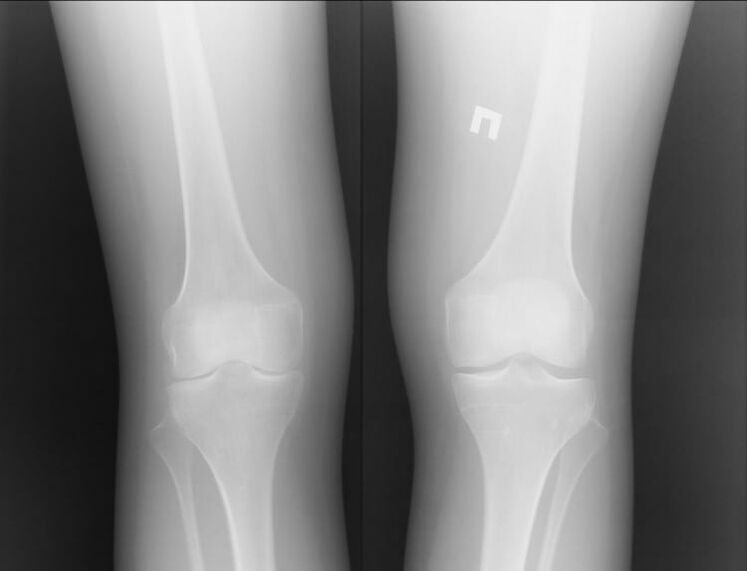 Röntgenbild der von Arthrose betroffenen Knie