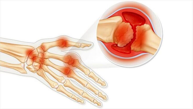 Schädigung der Handgelenke durch Arthritis