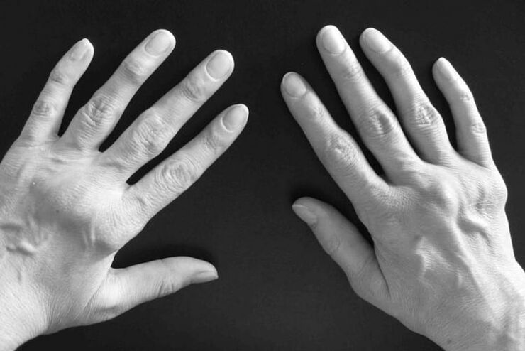 Symptome einer Arthritis in den Gelenken der Hände