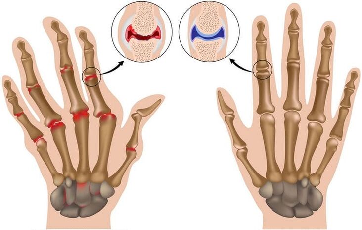 gesunde Handgelenke und durch Arthrose geschädigte Gelenke