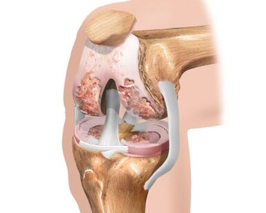 Zerstörung des Kniegelenks durch Arthrose