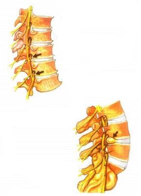 Illustration der spinalen Osteochondrose